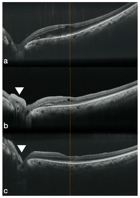 Applications Of The Amniotic Membrane In Vitreoretinal Surgery