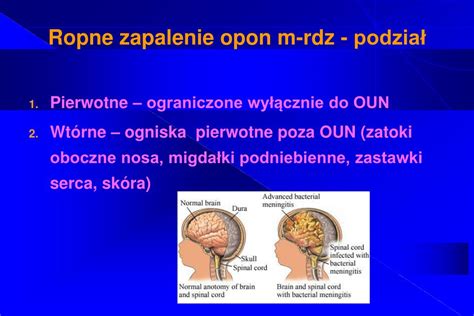 PPT Ropne zapalenia opon mózgowo rdzeniowych i mózgu dr n med