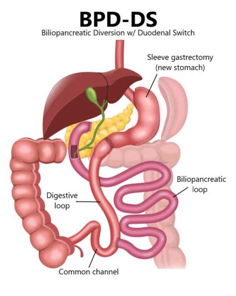 Duodenal Switch Astramedica