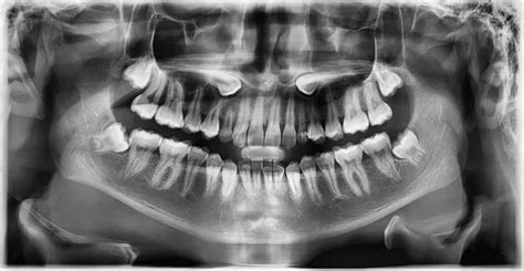 Do I Have Impacted Canine Teeth