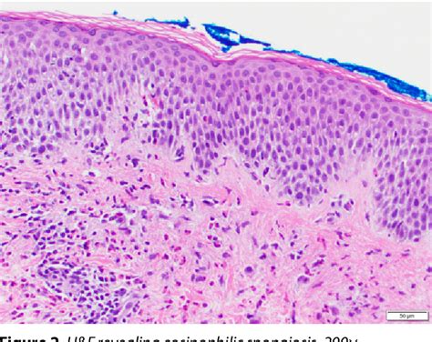 Pdf Successful Treatment Of Bullous Pemphigoid With Dupilumab A Case