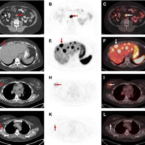 Follow Up 68 Ga DOTATATE PET CT After 9 Months Of Lanreotide