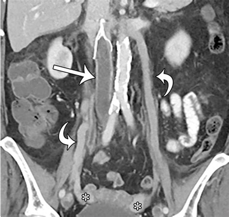 Imaging Appearance And Nonsurgical Management Of Pelvic Venous