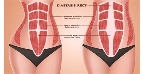 Abdominal Separation Diastasis Recti Prohealth Sports Spinal