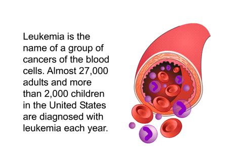 Leukemia