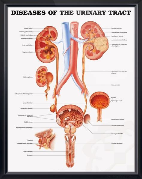 Diseases Of The Urinary Tract Anatomy Poster Urology Poster Illustrates