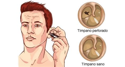 Perforación del Tímpano qué es síntomas y tratamiento Top Doctors