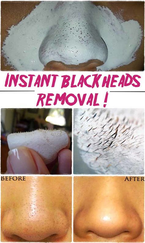 Say Goodbye Blackheads In 15 Minutes Homemadelifeproject