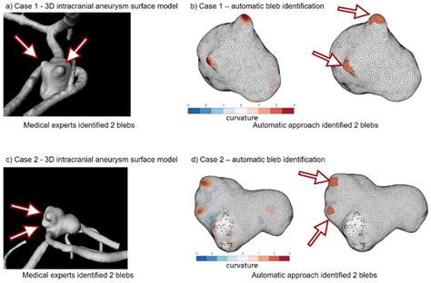 E 068 Towards Automated Intracranial Aneurysmal Bleb Detection