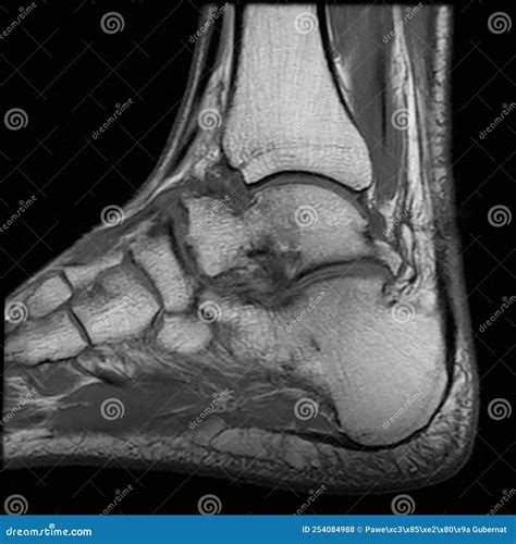 Magnetic Resonance Imaging - Image of the Left Ankle Joint after Trauma