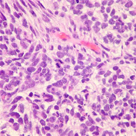 Lung Carcinoma Histology