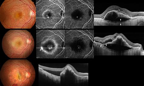 Retinal Pigment Epithelial Tear After Intravitreal Ranibizumab