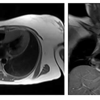 Cardiac MRI Showing Left Ventricular Hypertrophy In Patient 2 III