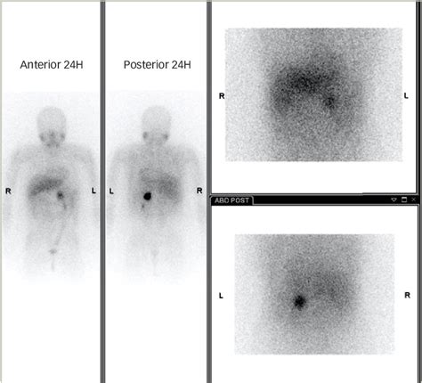 Figure 2 From Screening For Hereditary Pheochromocytoma In A Patient With Neurofibromatosis Type