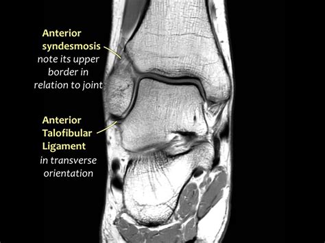 Talonavicular Ligament Mri