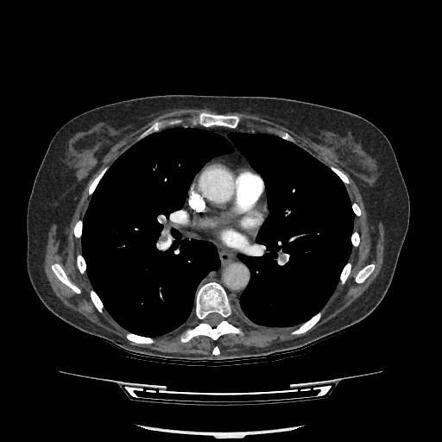 Pulmonary Embolism Image Radiopaedia Org