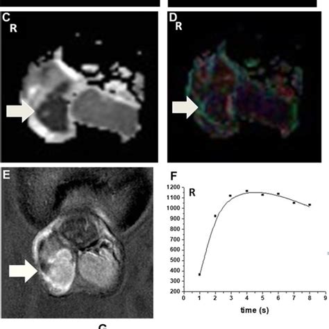 Right Testicular Seminoma In A 42 Year Old Man Invading The Testicular