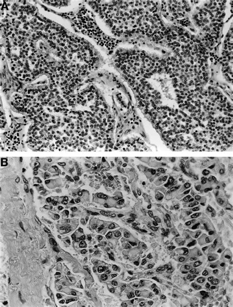 A Photomicrograph Showing Typical Morphology Of Low Grade Endocrine