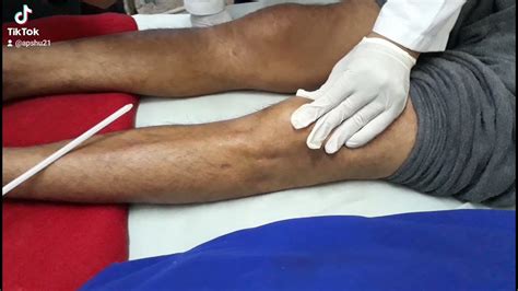 Well Demonstration Of Patellar And Ankle Clonus In Longitudinally