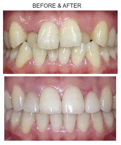 Orthodontic Treatment Before After Image In Dubai UAE BEST