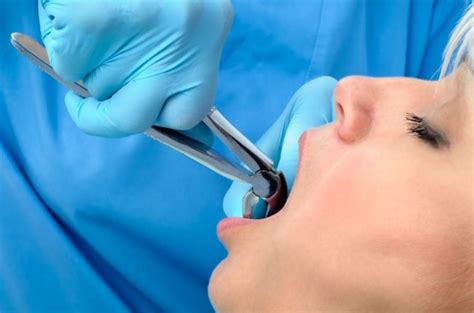 Tooth Extraction Management And Aftercare Tips Sydney Cbd Dentistry