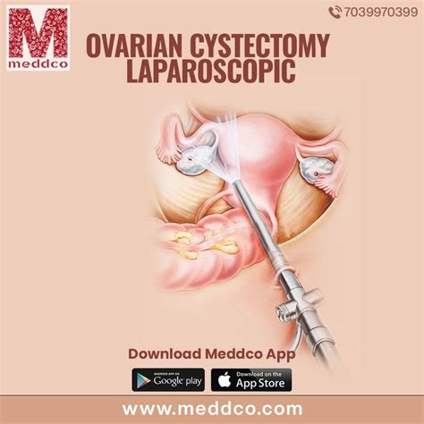 Ovarian Cystectomy Laparoscopic Ovarian Health Check Acupressure