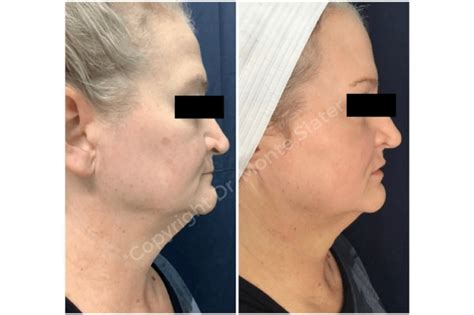 Virtue Rf Microneedling Archives Slater Aesthetics