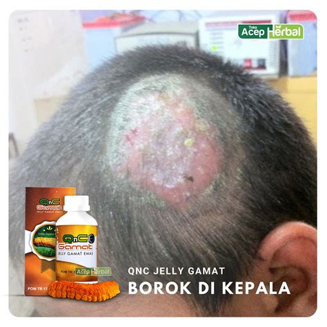 Obat Kulit Kepala Borok Obat Infeksi Jamur Di Kulit Kepala Mengelupas