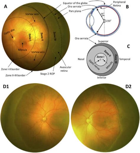 A Representative Fundus Images Captured With The Prototype Pedcam