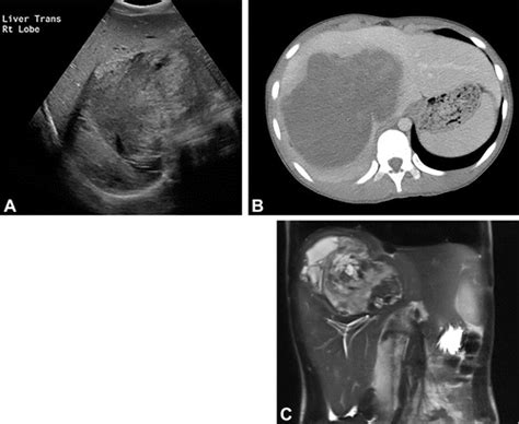 Pediatric Hepatic Cystic Lesions Differential Diagnosis And