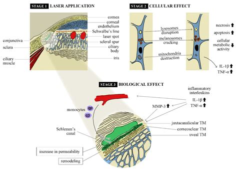 JCM Free Full Text Selective Laser Trabeculoplasty In The Treatment