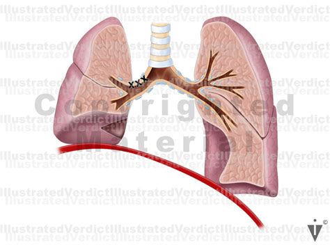 Case At A Glance Lung Cancer Right Upper Lobectomy Illustrated Verdict