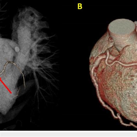 Coronary Arteries In Three Dimensional Volume Rendering 3DVR A