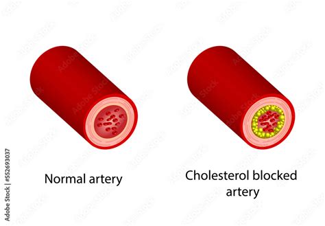 Normal Artery Versus Narrowed Artery Blocked With Cholesterol Plaque