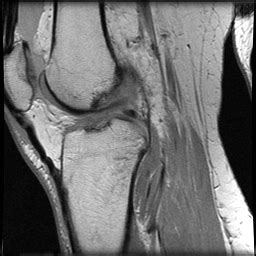 ACL MRI Results