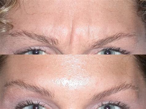 In Office Botox Injections At Artemedica In Santa Rosa And Healdsburg