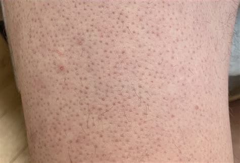 Keratosis Pilaris Central Wyoming Skin Clinic