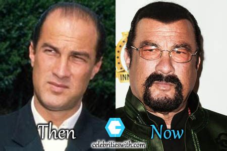 Steven Seagal Plastic Surgery, Hair Transplant, Before and After ...