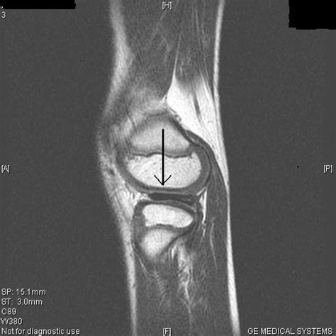 Discoid Lateral Meniscus Mri Sumer S Radiology Blog