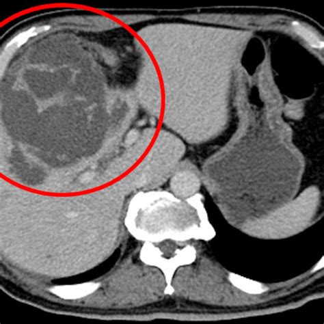 Contrast Enhanced Abdominal CT Demonstrated Enlarged And Multifocal