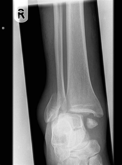 Trimalleolar Fracture Image Radiopaedia Org