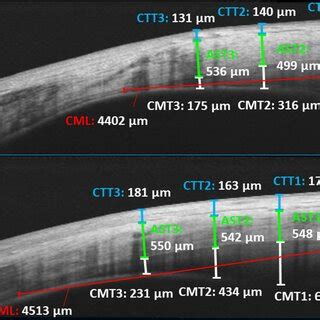 Comparison in conjunctival-Tenon’s capsule thickness, anterior scleral ...