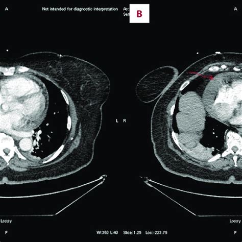 PDF Atypical Presentation Of Small Lymphocytic Lymphoma With