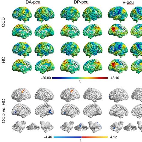 Correlations Between The Altered Precuneus Subregion To Functional