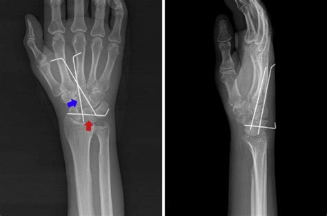 Postoperative Posteroanterior Left And Lateral Right Radiographs