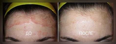 Псоркутан: цена, инструкция по применению