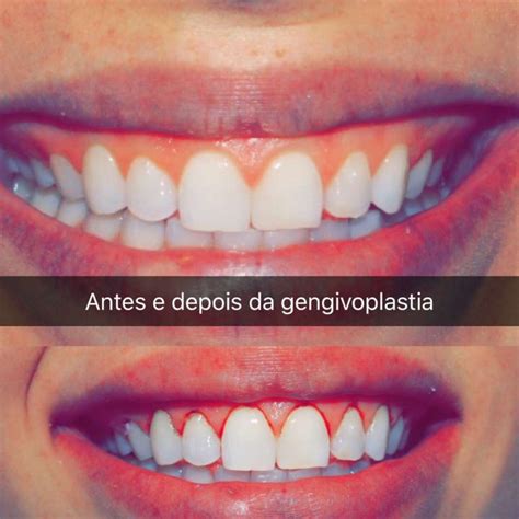 Gengivoplastia Valor Antes E Depois Como Feita E Mais