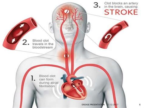 Stroke Presentation Ppt