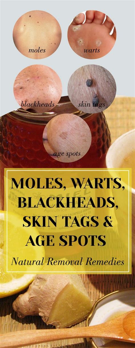 Moles, Warts, Blackheads, Skin Tags And Age Spots – Natural Removal ...