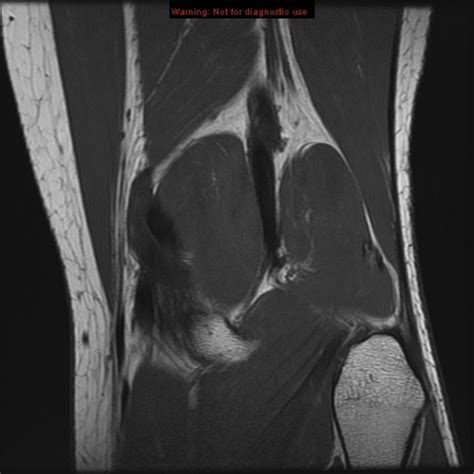 Knee MRI coronal 13 Diagram | Quizlet